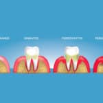 cual es la diferencia entre gingivitis y periodontitis una mirada a las enfermedades periodontales