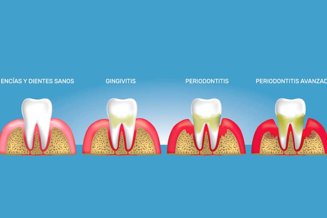 cual es la diferencia entre gingivitis y periodontitis una mirada a las enfermedades periodontales