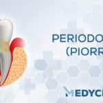cual es la diferencia entre piorrea y periodontitis comprende sus principales caracteristicas