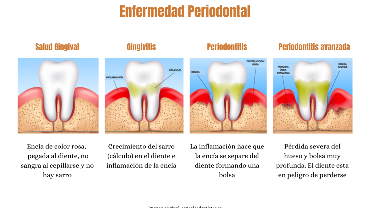 descubre la diferencia entre el mantenimiento periodontal y la limpieza consejos para una mejor salud bucal