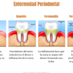 descubre la diferencia entre el mantenimiento periodontal y la limpieza consejos para una mejor salud bucal