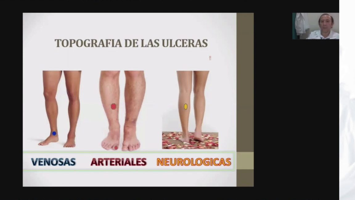 descubre las diferencias entre una ulcera venosa y una ulcera arterial