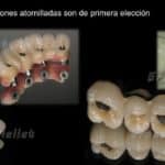 guia completa para comprender la diferencia entre implantes dentales atornillados y cementados