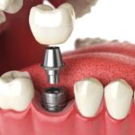 que diferencia hay entre los implantes dentales atornillados y cementados