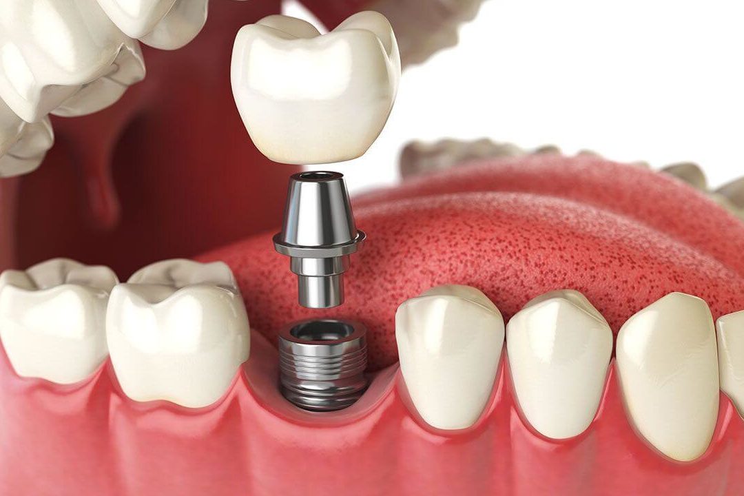 que diferencia hay entre los implantes dentales atornillados y cementados