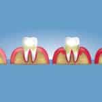 periodontitis vs piorrea descubra la diferencia entre estas enfermedades orales