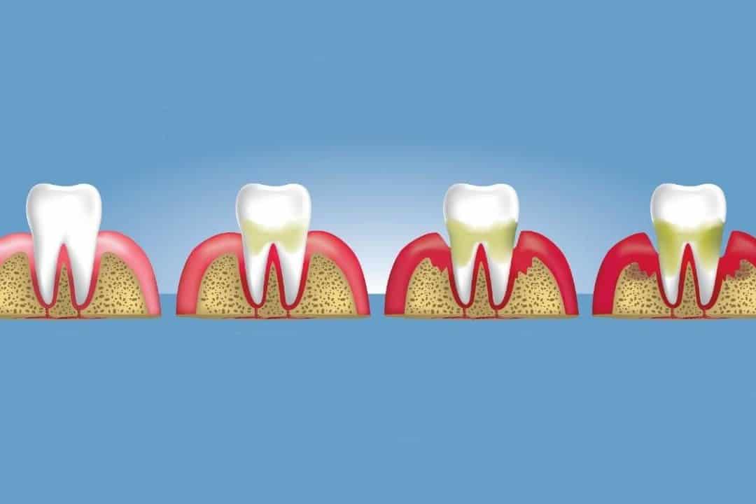 periodontitis vs piorrea descubra la diferencia entre estas enfermedades orales
