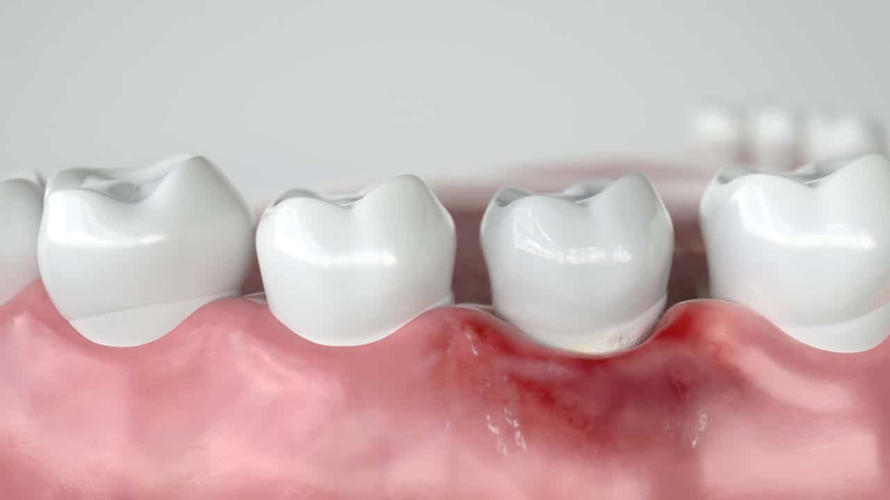 cuales son las diferencias entre gingivitis y periodontitis explicacion completa