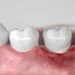 cuales son las diferencias entre gingivitis y periodontitis explicacion completa