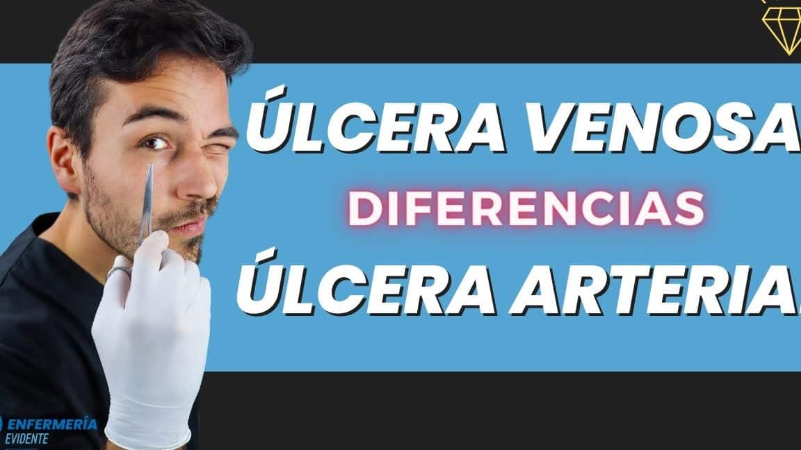 cuales son las diferencias entre una ulcera venosa y una ulcera arterial descubre aqui