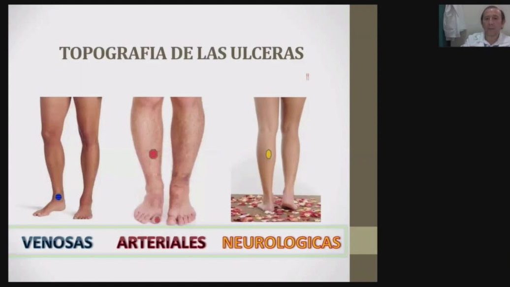 descubre las principales diferencias entre ulcera venosa y arterial