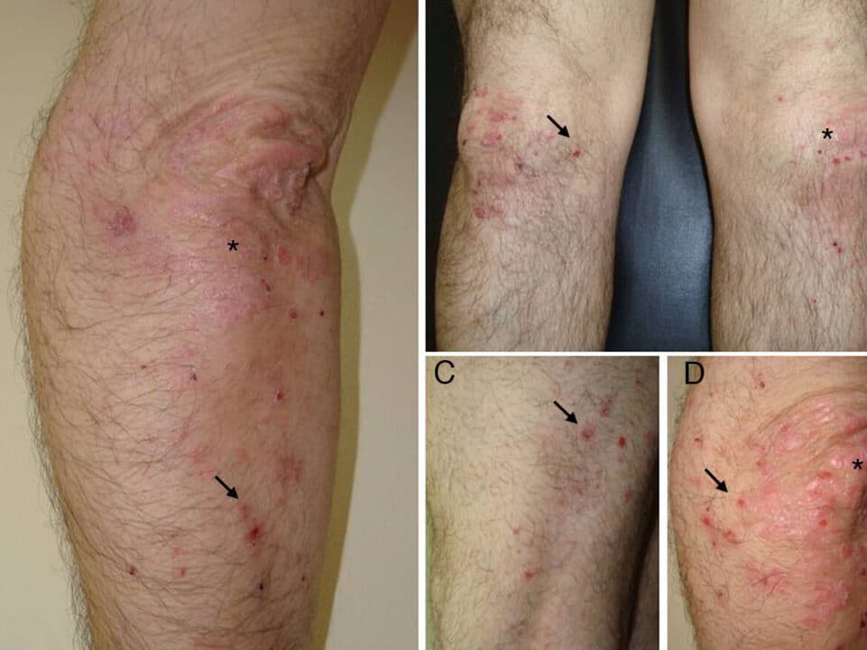 dermatitis vs psoriasis analizando las diferencias entre estas afecciones cutaneas