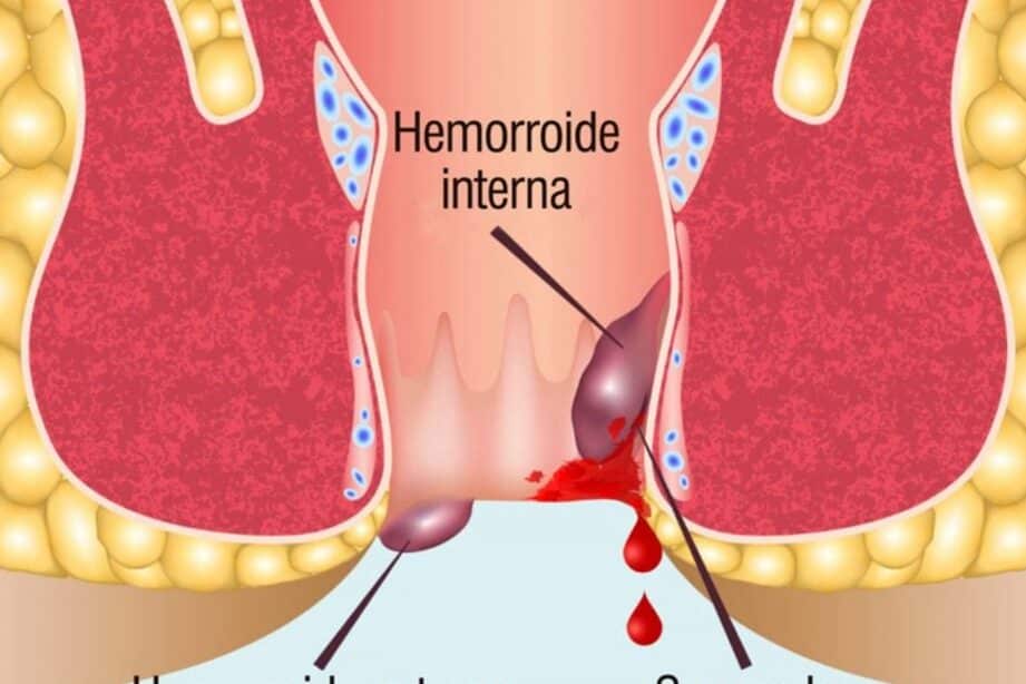 descubre las principales diferencias entre almorranas y hemorroides sintomas causas y tratamientos