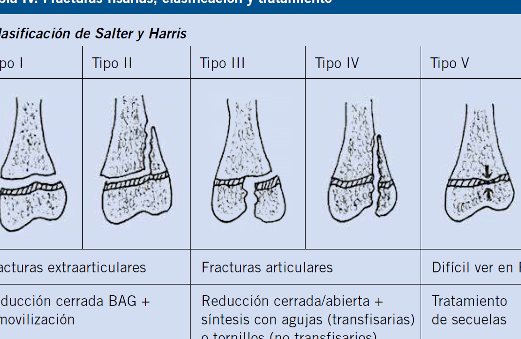 diferencias entre anillos y placas de castilago todo lo que necesitas saber