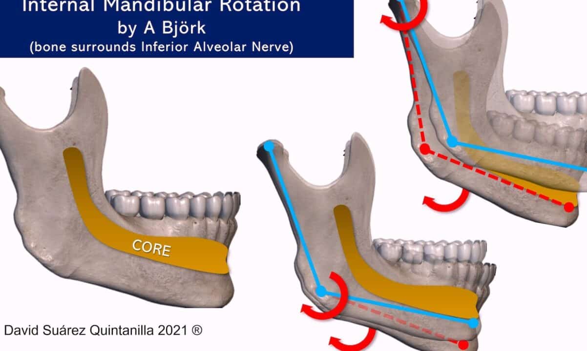 diferencias entre el hueso maxilar y mandibular todo lo que necesitas saber