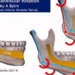 diferencias entre el hueso maxilar y mandibular todo lo que necesitas saber