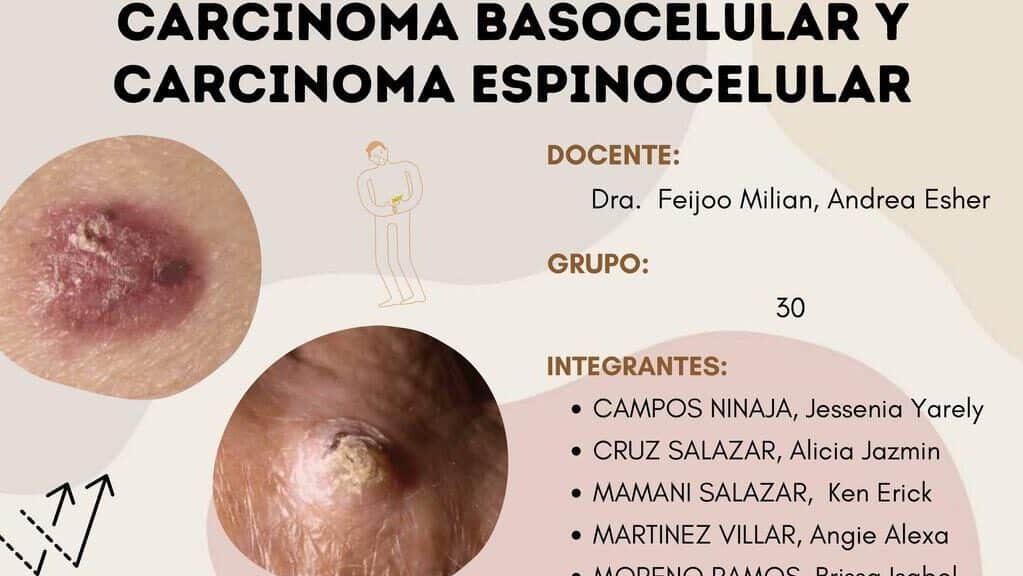 diferencias entre carcinoma basocelular y espinocelular cual es la clave para el diagnostico y tratamiento