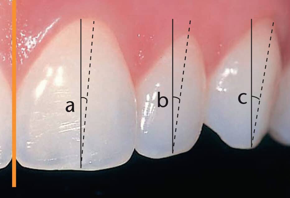 diferencias entre incisivos superiores e inferiores cual es la clave para una sonrisa perfecta