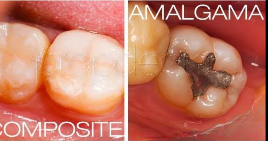 diferencias entre aleacion metalica y amalgama dental cual es la mejor opcion para tratamientos dentales