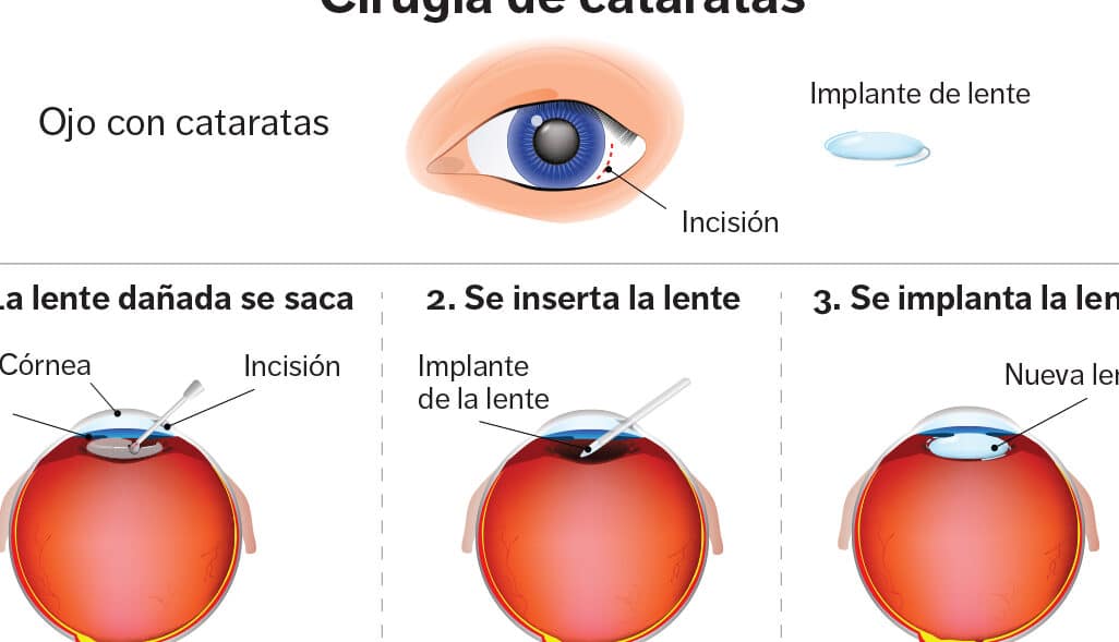 diferencias entre cirugia de cataratas tradicional y mecanica cual es la mejor opcion para ti