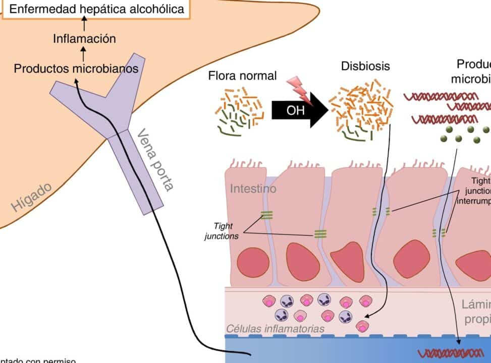 las diferencias clave entre cirrosis hepatica y hepatitis alcoholica guia completa