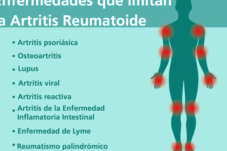 diferencias clave entre la artritis reumatoide y el lupus como distinguirlos