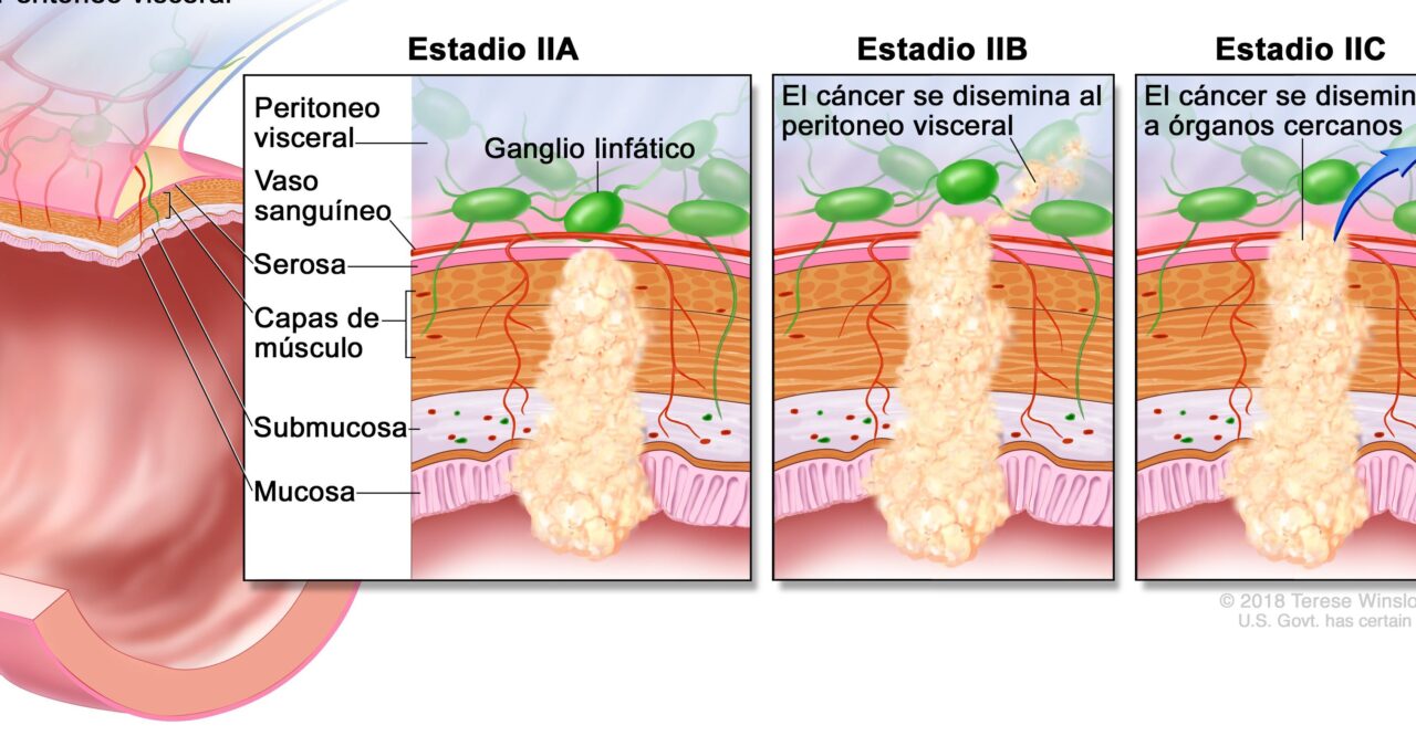 diferencias entre sii y cancer de colon todo lo que necesitas saber